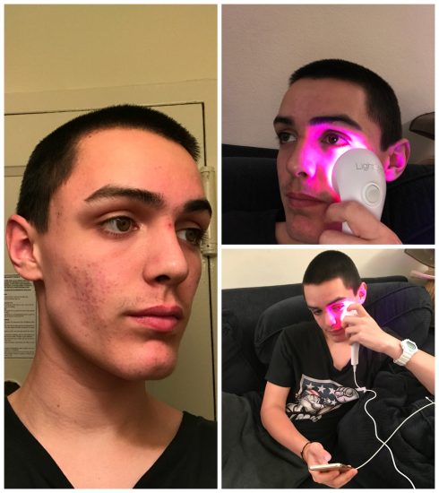 LightStim! Helps With Acne, Pain, and Wrinkles!
